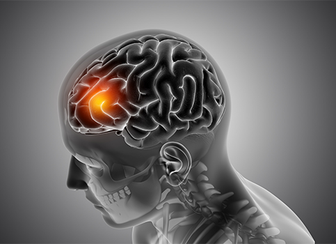 Ataxia