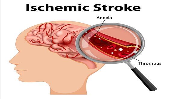 stroke1
